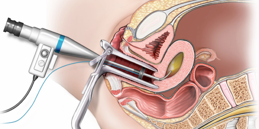 Histeroskopi Yapışıklık Ameliyatı