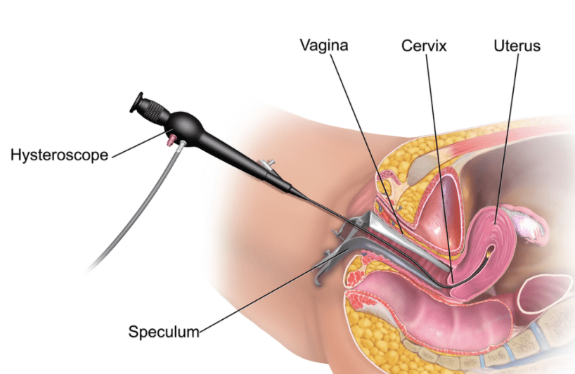 Histeroskopik miyom ameliyatı nasıl yapılır?