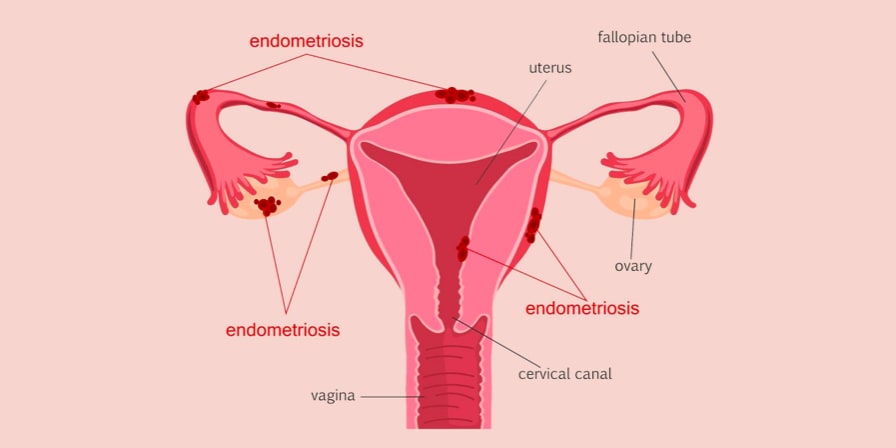 Endometriyozis Nedir?