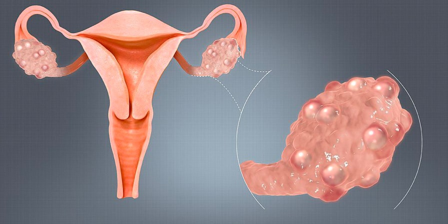 Polikistik Over Sendromu Nedir? Kist midir?